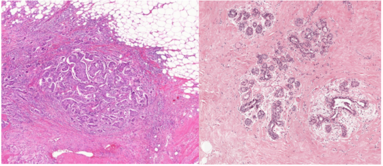 IDC Type Breast Cancer Classification Mahesh Sudhakar